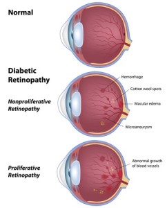 11578735 - diabetic retinopathy, eye disease due to diabetes