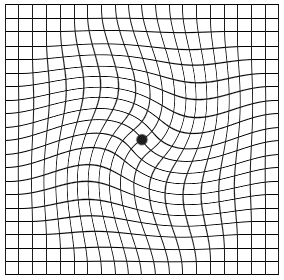 abnormal Amsler Grid test