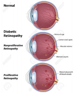 Diabetic Retinopathy- Retina Ophthalmologist in Frederick MD