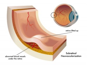 Amsler Grid Test- Retina Ophthalmology Gettysburg PA - Greater Potomac  Retina