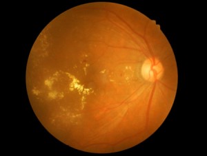 25978767 - medical photo retinal of diabetic