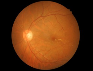 26024781 - medical photo retinal of diabetic