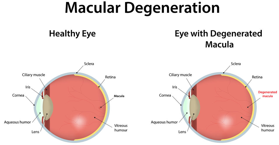30636757 - age related macular degeneration