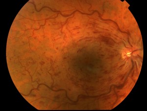 CRVO Retina Ophthalmologist Frederick MD