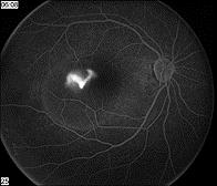 Central Serous Chorioretinopathy