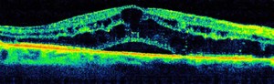Cystoid Macular Edema- Retina Ophthalmologist Gettysburg PA & Frederick MD