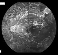 Fluorescein Angiography