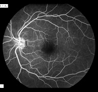 Fluorescein Angiography1