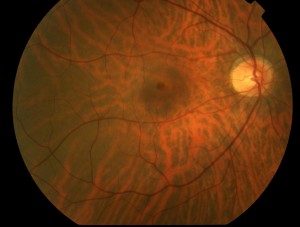 Macular Hole retina ophthamologist getttysburg pa