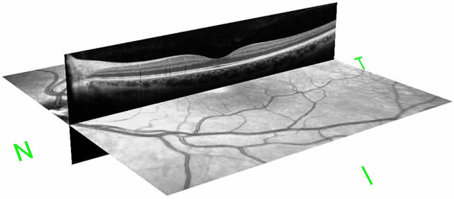 Optical Coherence Tomography