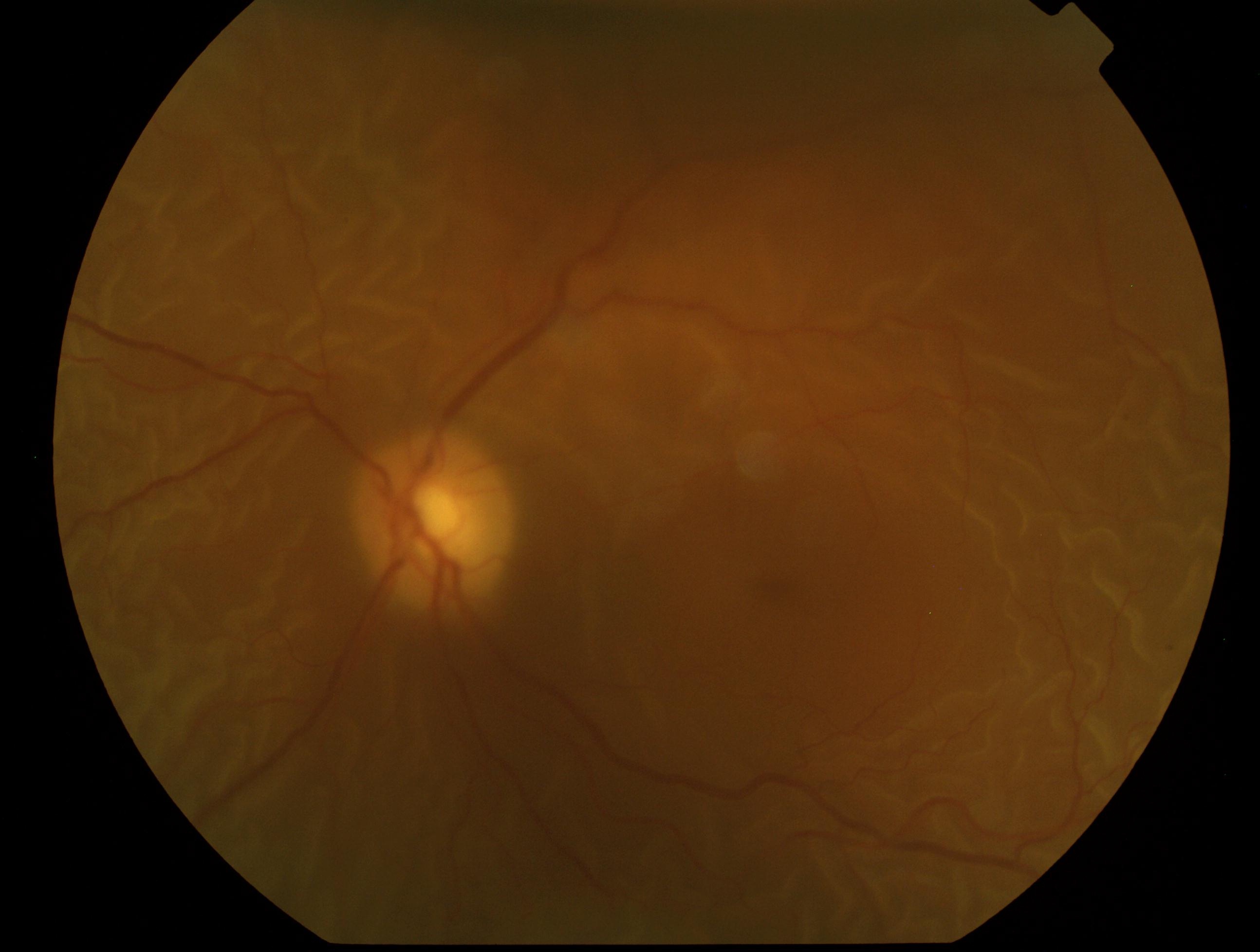 detached retina detached retina